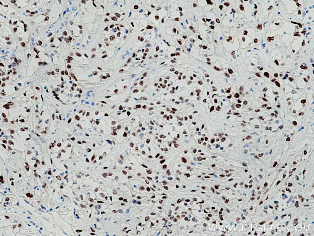 Immunohistochemistry (IHC) staining of human renal cell carcinoma tissue using PAX8 Polyclonal antibody (10336-1-AP)