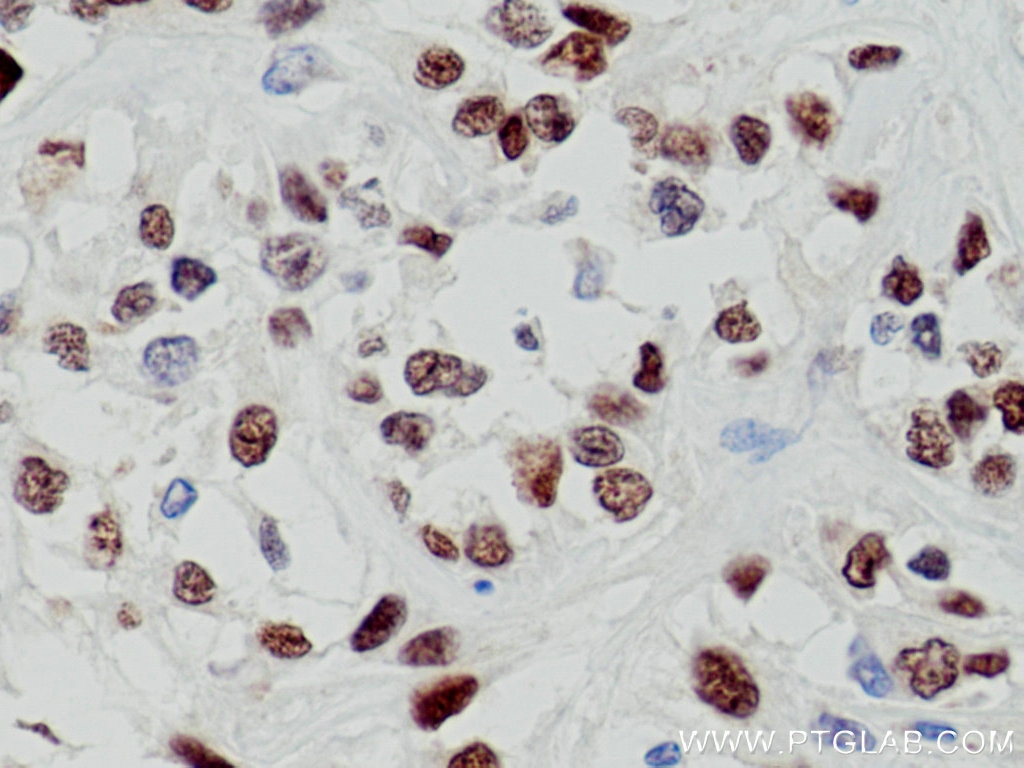 Immunohistochemistry (IHC) staining of human renal cell carcinoma tissue using PAX8 Polyclonal antibody (10336-1-AP)