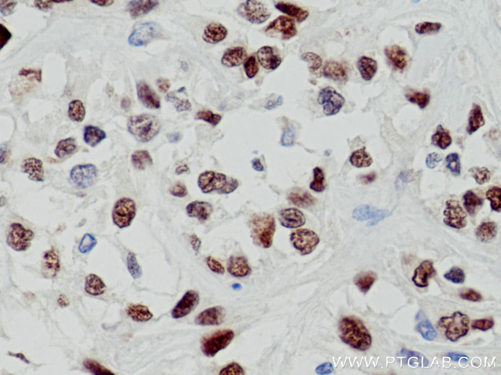 IHC staining of human renal cell carcinoma using 10336-1-AP