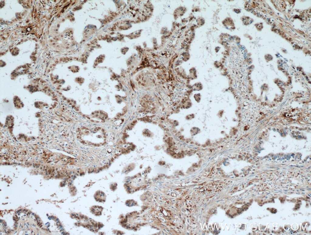 Immunohistochemistry (IHC) staining of human ovary tumor tissue using PAX8 Polyclonal antibody (22255-1-AP)