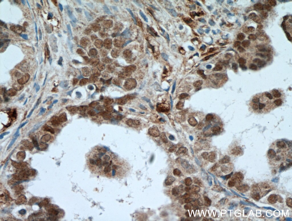 Immunohistochemistry (IHC) staining of human ovary tumor tissue using PAX8 Polyclonal antibody (22255-1-AP)