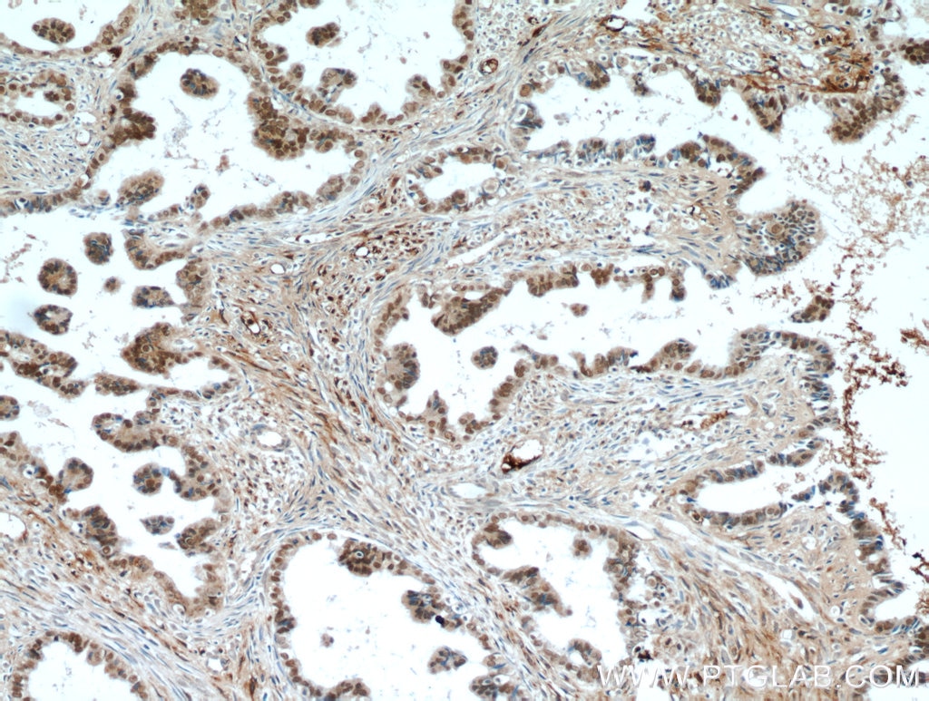 Immunohistochemistry (IHC) staining of human ovary tumor tissue using PAX8 Polyclonal antibody (22255-1-AP)