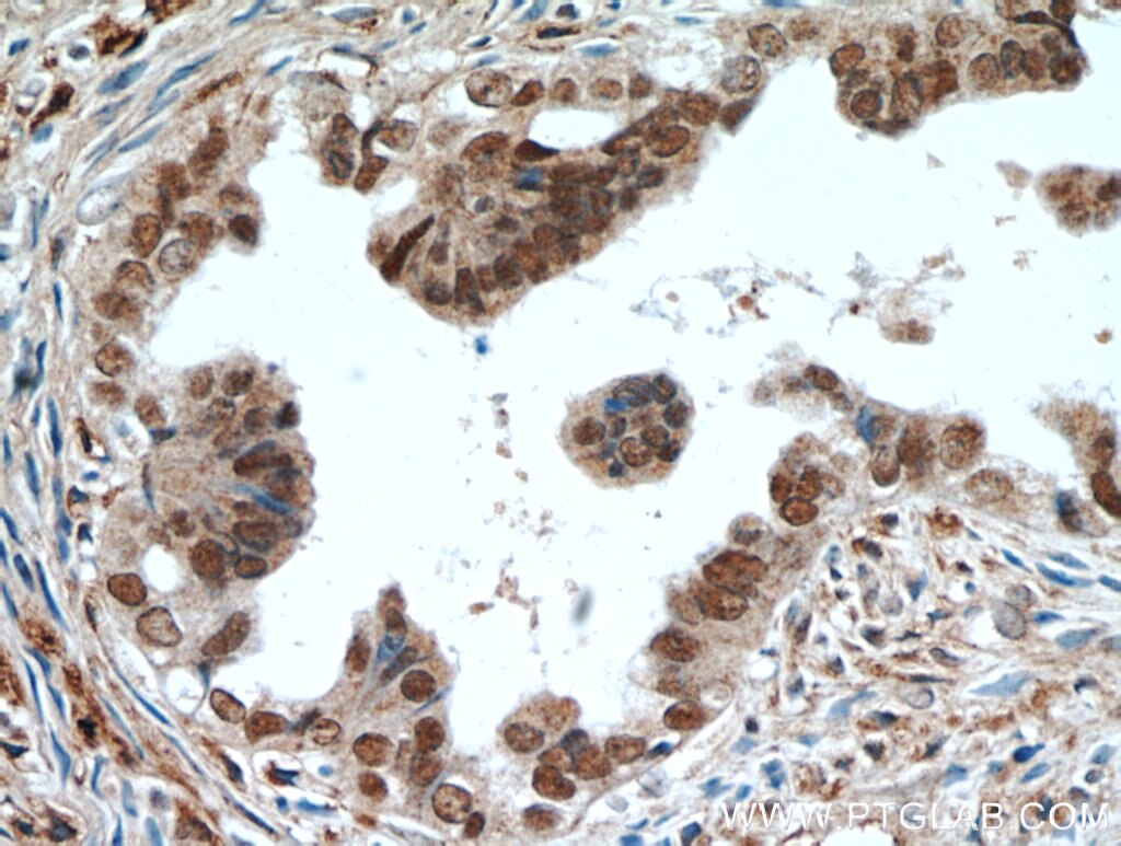 Immunohistochemistry (IHC) staining of human ovary tumor tissue using PAX8 Polyclonal antibody (22255-1-AP)