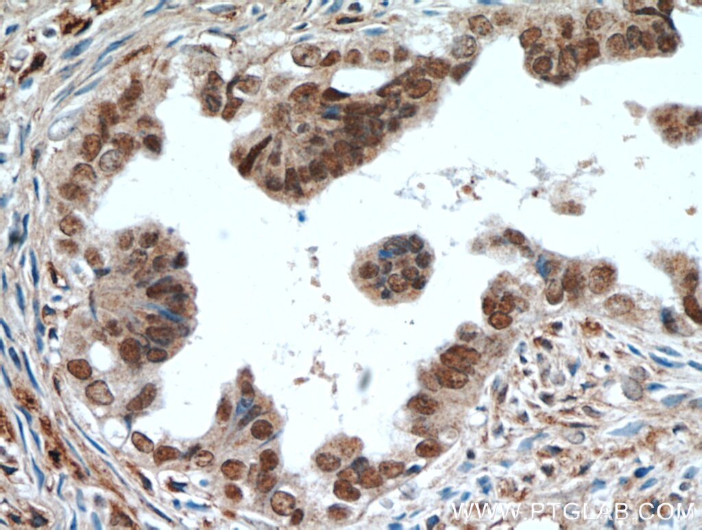 IHC staining of human ovary tumor using 22255-1-AP