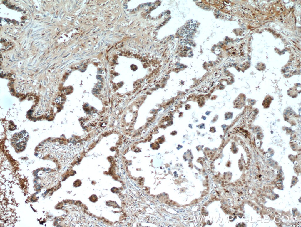 Immunohistochemistry (IHC) staining of human ovary tumor tissue using PAX8 Polyclonal antibody (22255-1-AP)