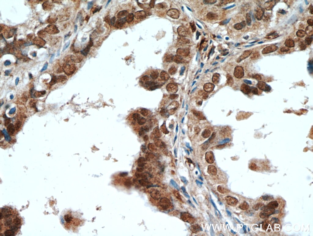 Immunohistochemistry (IHC) staining of human ovary tumor tissue using PAX8 Polyclonal antibody (22255-1-AP)