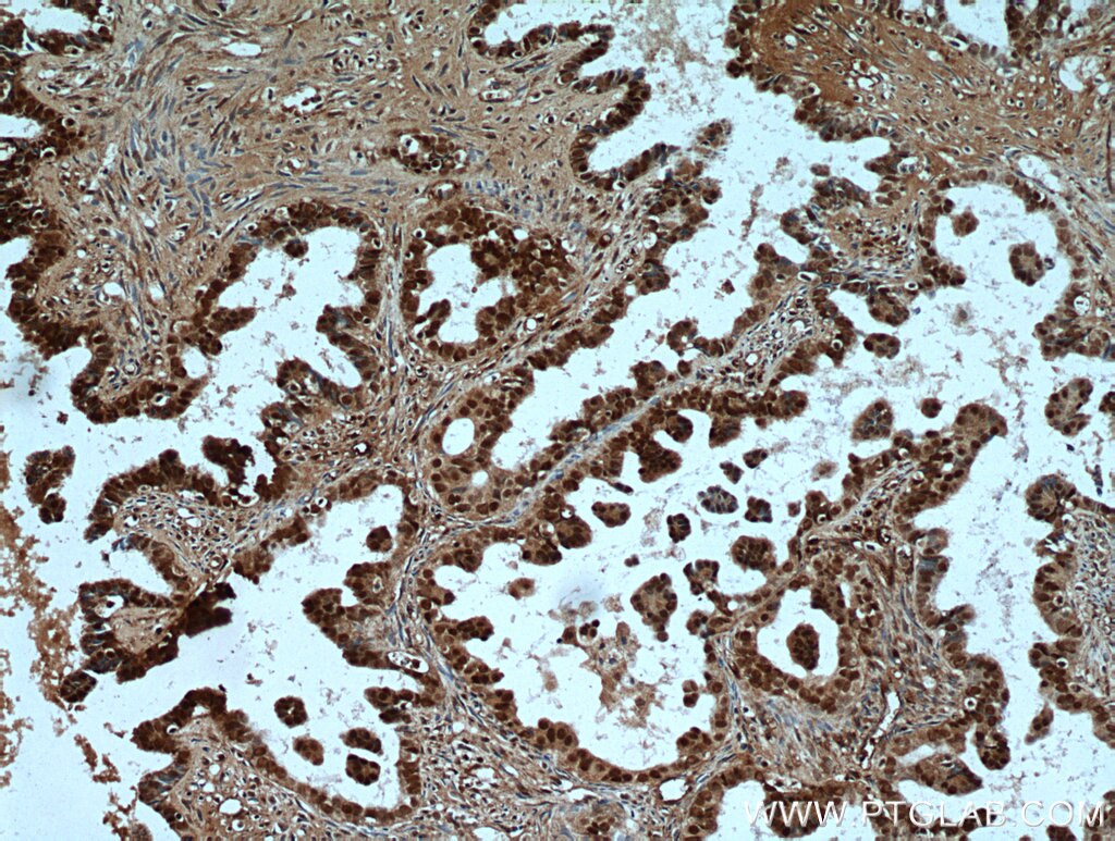 Immunohistochemistry (IHC) staining of human ovary tumor tissue using PAX8 Polyclonal antibody (22255-1-AP)