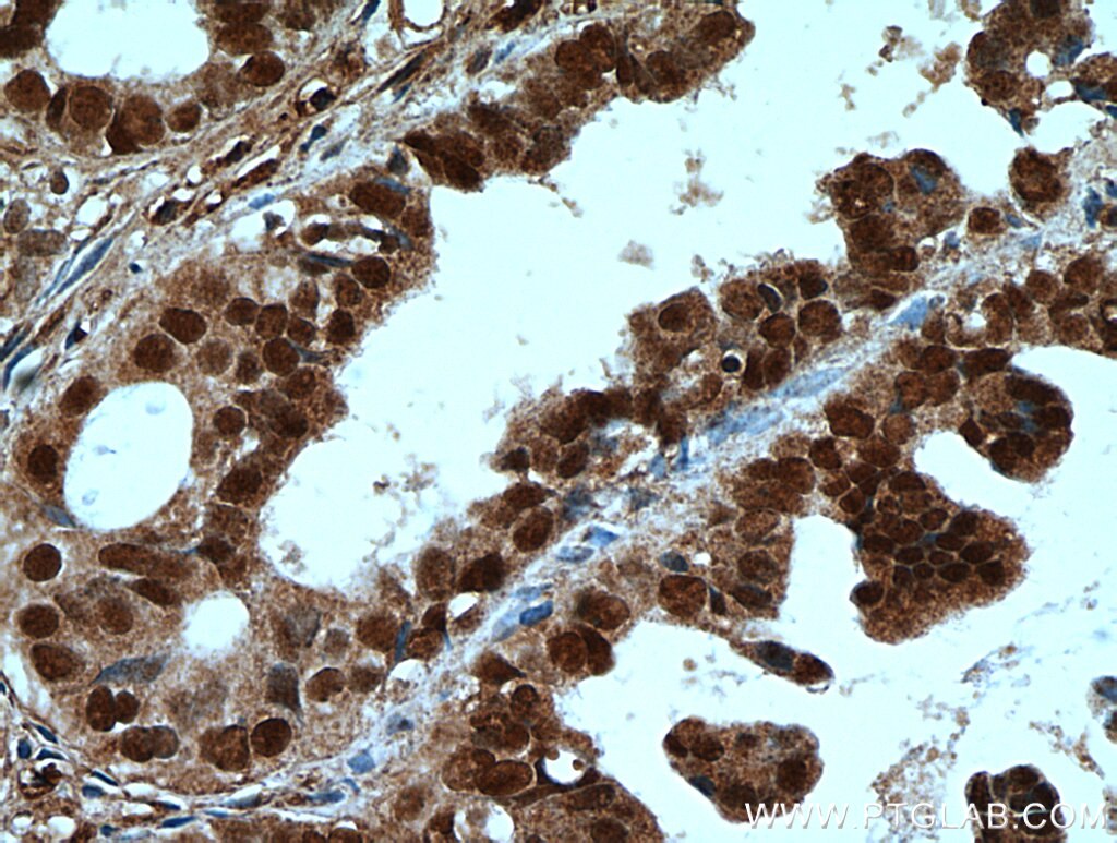 Immunohistochemistry (IHC) staining of human ovary tumor tissue using PAX8 Polyclonal antibody (22255-1-AP)