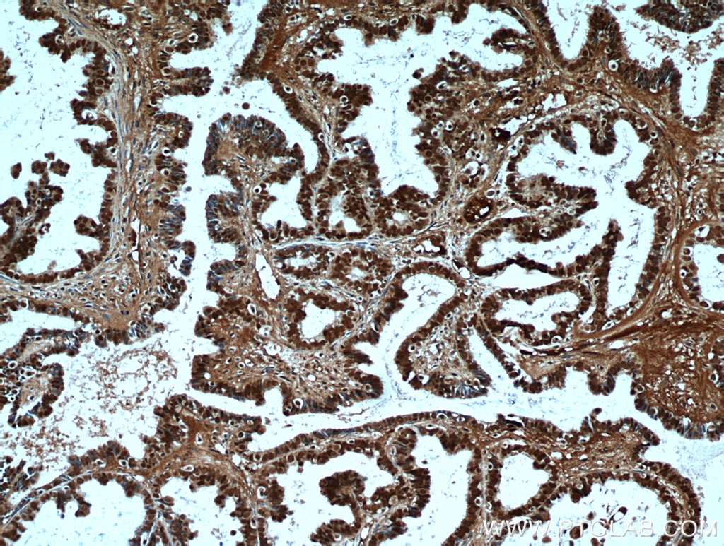 Immunohistochemistry (IHC) staining of human ovary tumor tissue using PAX8 Polyclonal antibody (22255-1-AP)