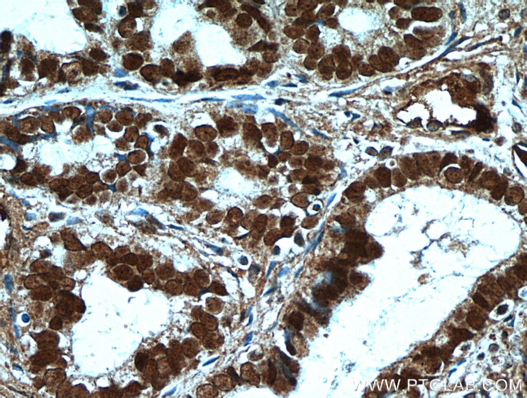 Immunohistochemistry (IHC) staining of human ovary tumor tissue using PAX8 Polyclonal antibody (22255-1-AP)