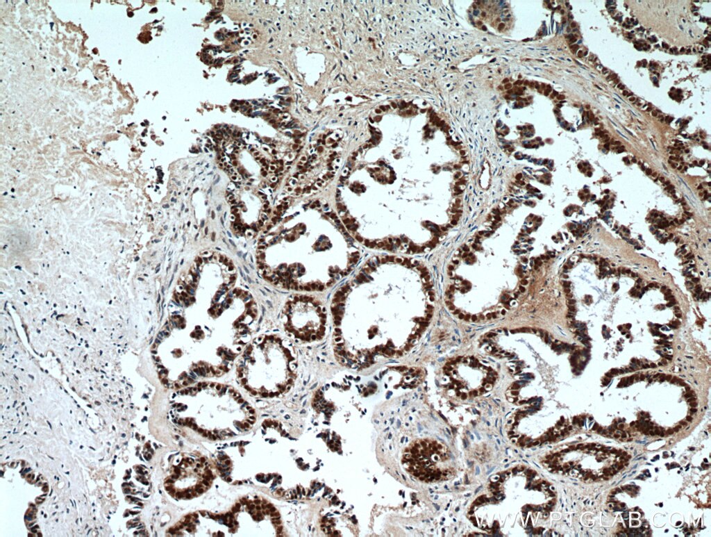 Immunohistochemistry (IHC) staining of human ovary tumor tissue using PAX8 Polyclonal antibody (22255-1-AP)