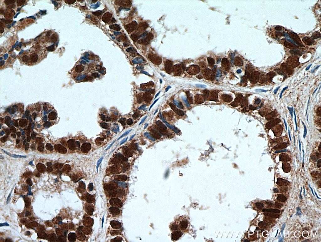 Immunohistochemistry (IHC) staining of human ovary tumor tissue using PAX8 Polyclonal antibody (22255-1-AP)