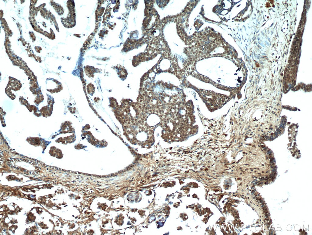 IHC staining of human ovary tumor using 22255-1-AP