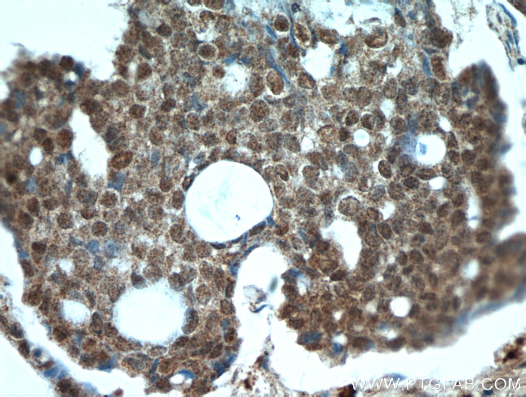 IHC staining of human ovary tumor using 22255-1-AP