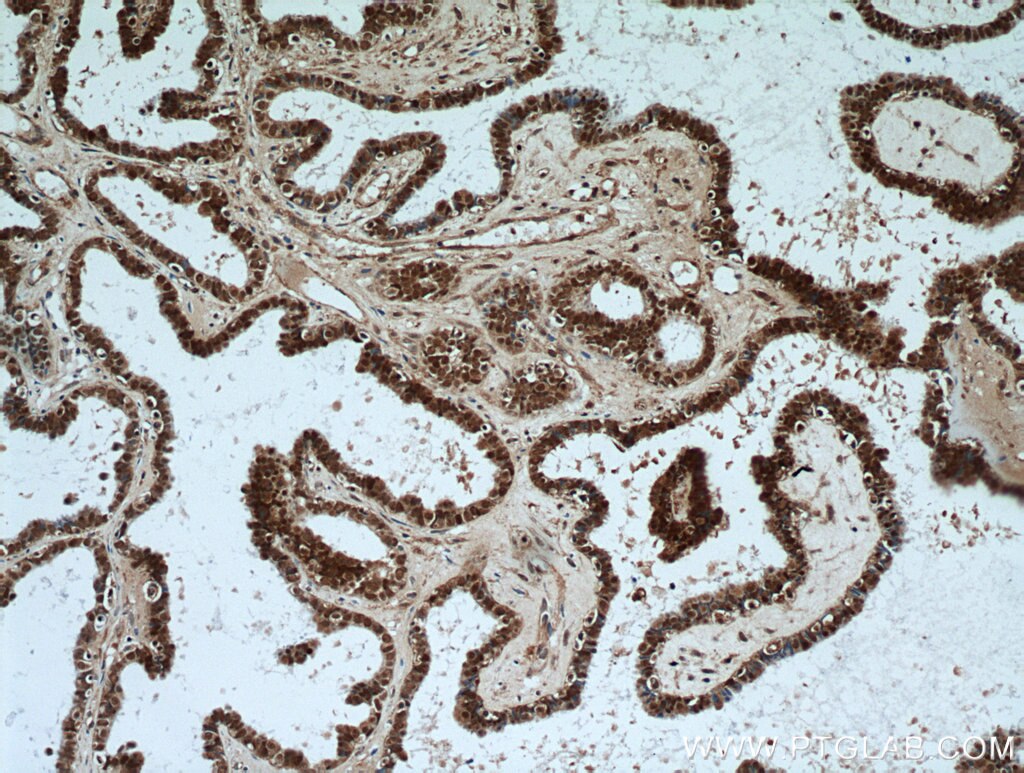 Immunohistochemistry (IHC) staining of human ovary tumor tissue using PAX8 Polyclonal antibody (22255-1-AP)