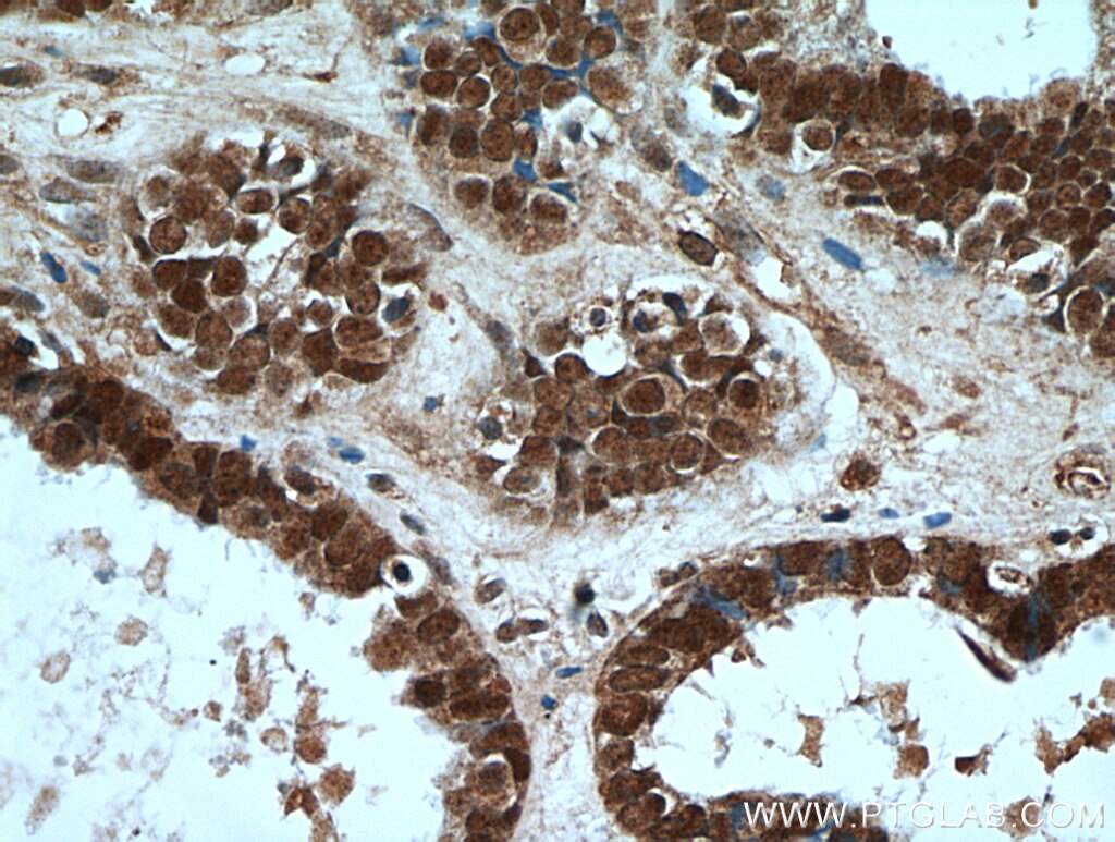 Immunohistochemistry (IHC) staining of human ovary tumor tissue using PAX8 Polyclonal antibody (22255-1-AP)