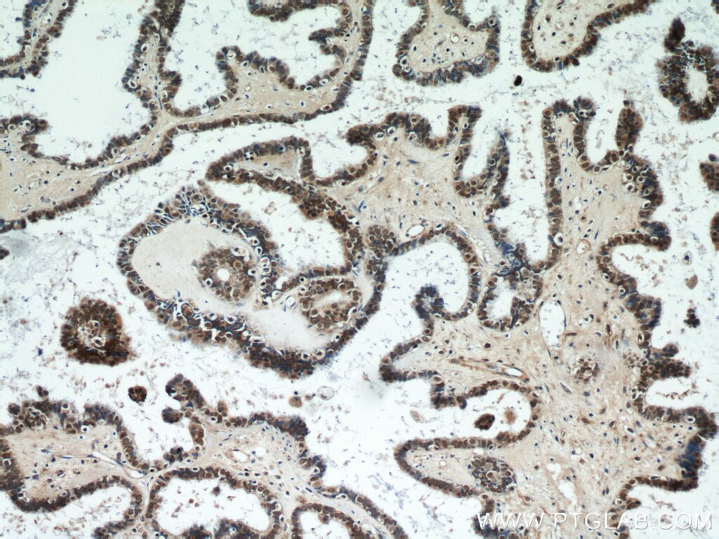 Immunohistochemistry (IHC) staining of human ovary tumor tissue using PAX8 Polyclonal antibody (22255-1-AP)