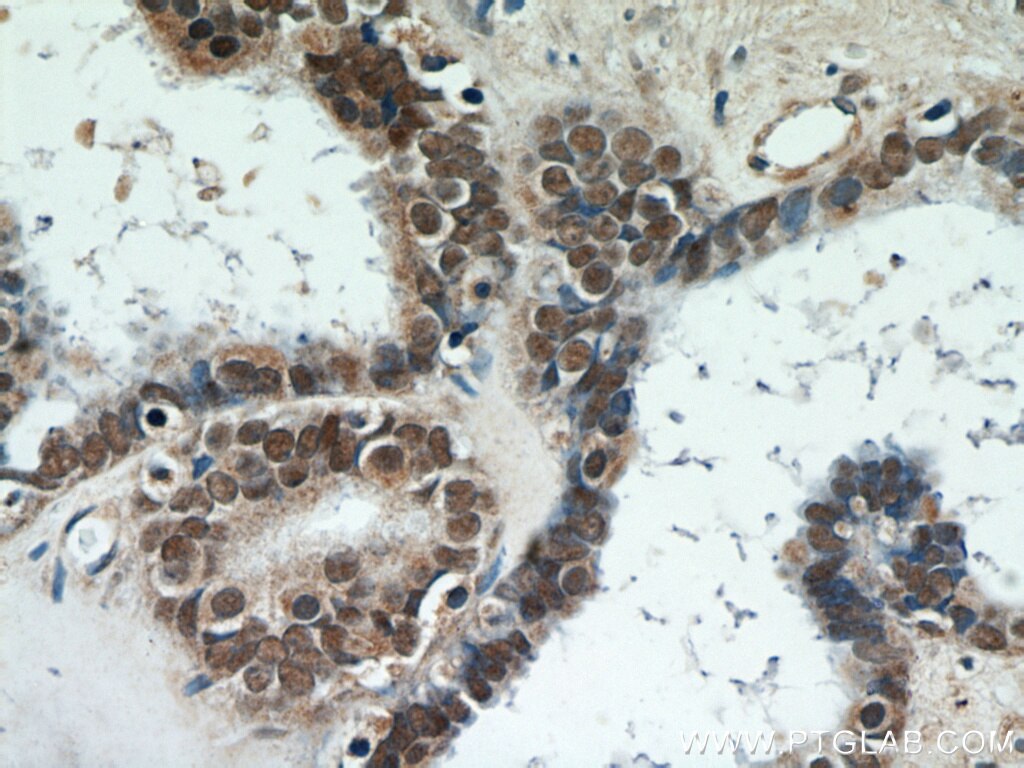 Immunohistochemistry (IHC) staining of human ovary tumor tissue using PAX8 Polyclonal antibody (22255-1-AP)