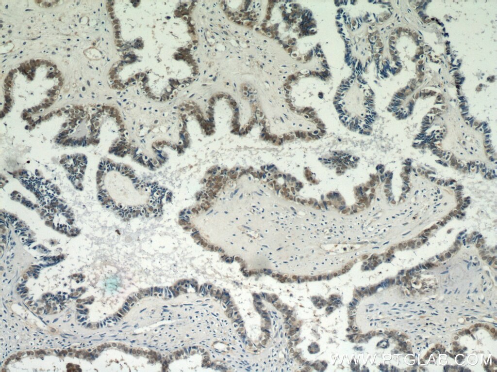 Immunohistochemistry (IHC) staining of human ovary tumor tissue using PAX8 Polyclonal antibody (22255-1-AP)