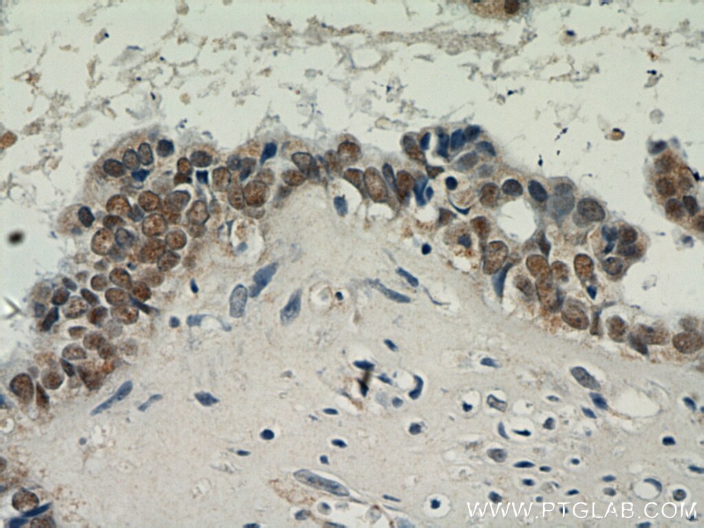 Immunohistochemistry (IHC) staining of human ovary tumor tissue using PAX8 Polyclonal antibody (22255-1-AP)