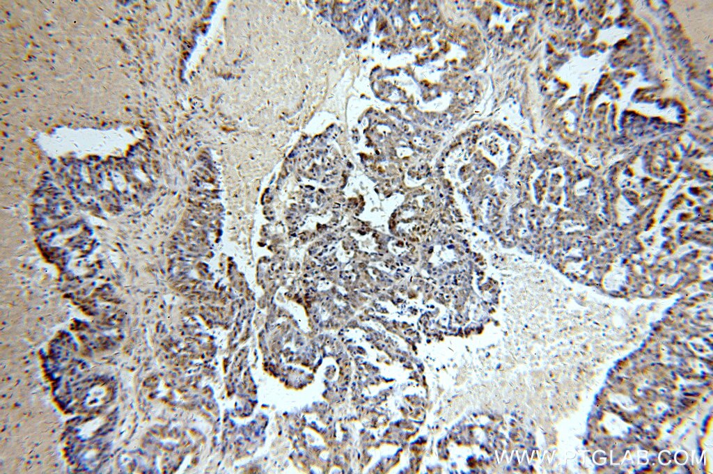 Immunohistochemistry (IHC) staining of human ovary tumor tissue using PAX8 Monoclonal antibody (60144-1-Ig)