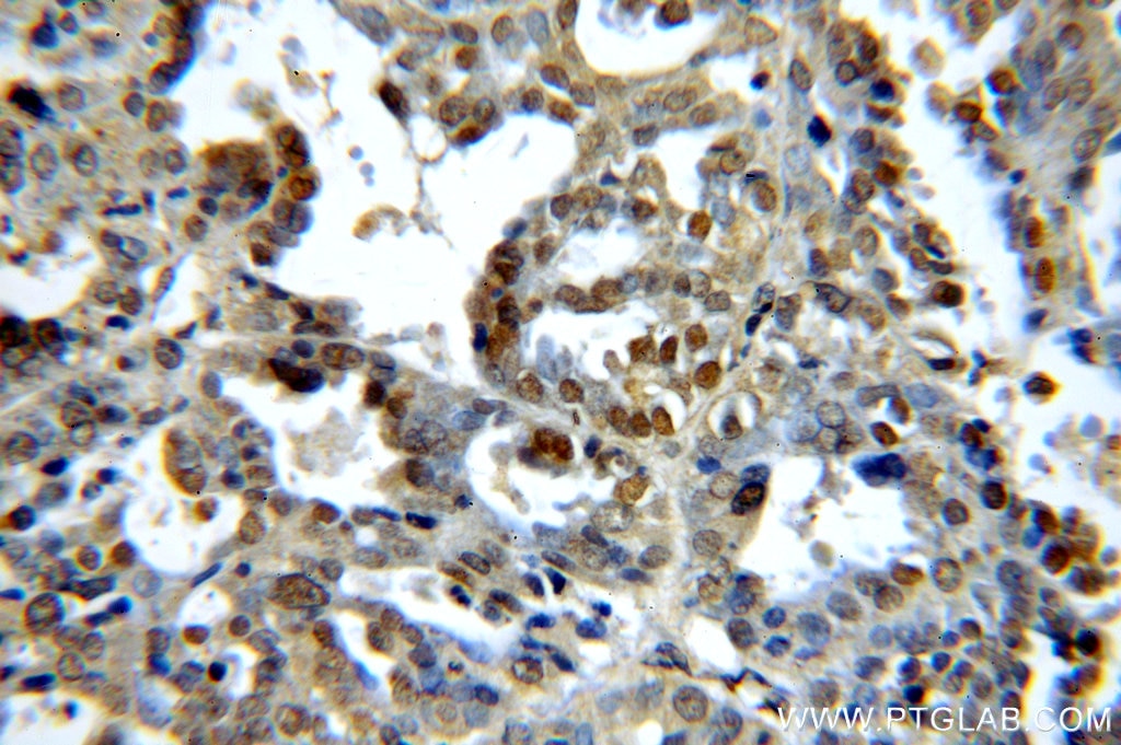 Immunohistochemistry (IHC) staining of human ovary tumor tissue using PAX8 Monoclonal antibody (60144-1-Ig)