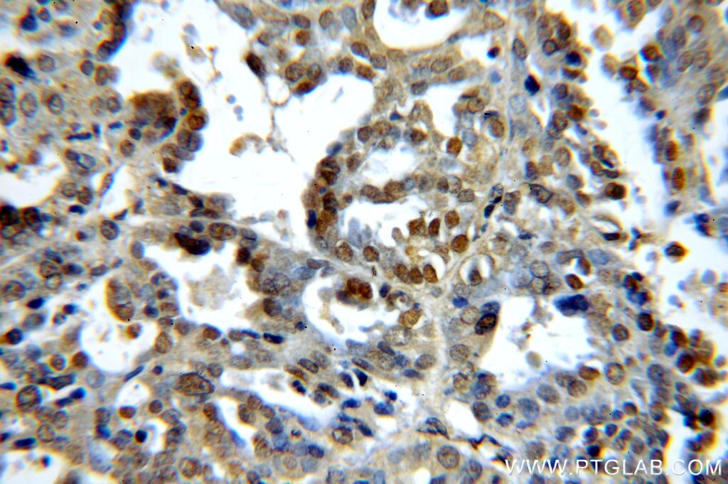 IHC staining of human ovary tumor using 60144-1-Ig