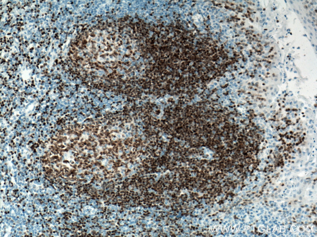 IHC staining of human tonsillitis using 60145-4-Ig