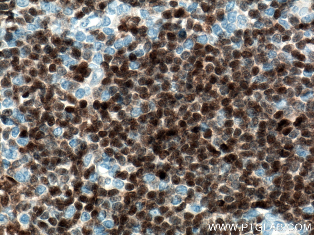 Immunohistochemistry (IHC) staining of human tonsillitis tissue using PAX8 Monoclonal antibody (60145-4-Ig)