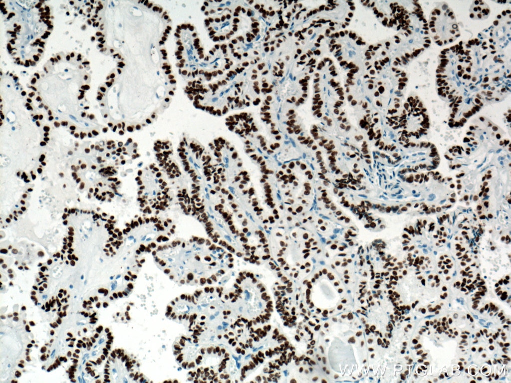 Immunohistochemistry (IHC) staining of human thyroid cancer tissue using PAX8 Monoclonal antibody (60145-4-Ig)