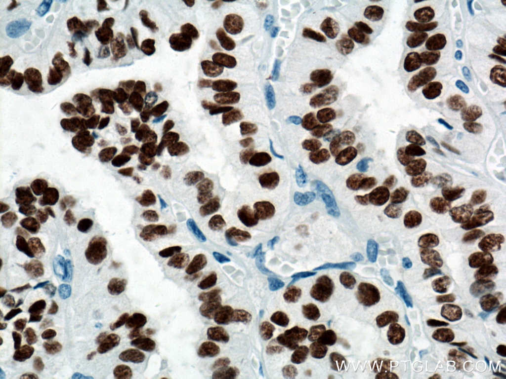 Immunohistochemistry (IHC) staining of human thyroid cancer tissue using PAX8 Monoclonal antibody (60145-4-Ig)