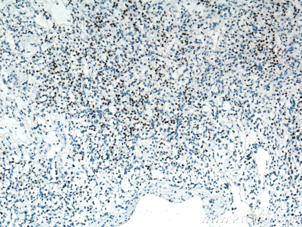 PAX8 Antibody IHC human renal cell carcinoma tissue 60145-4-Ig