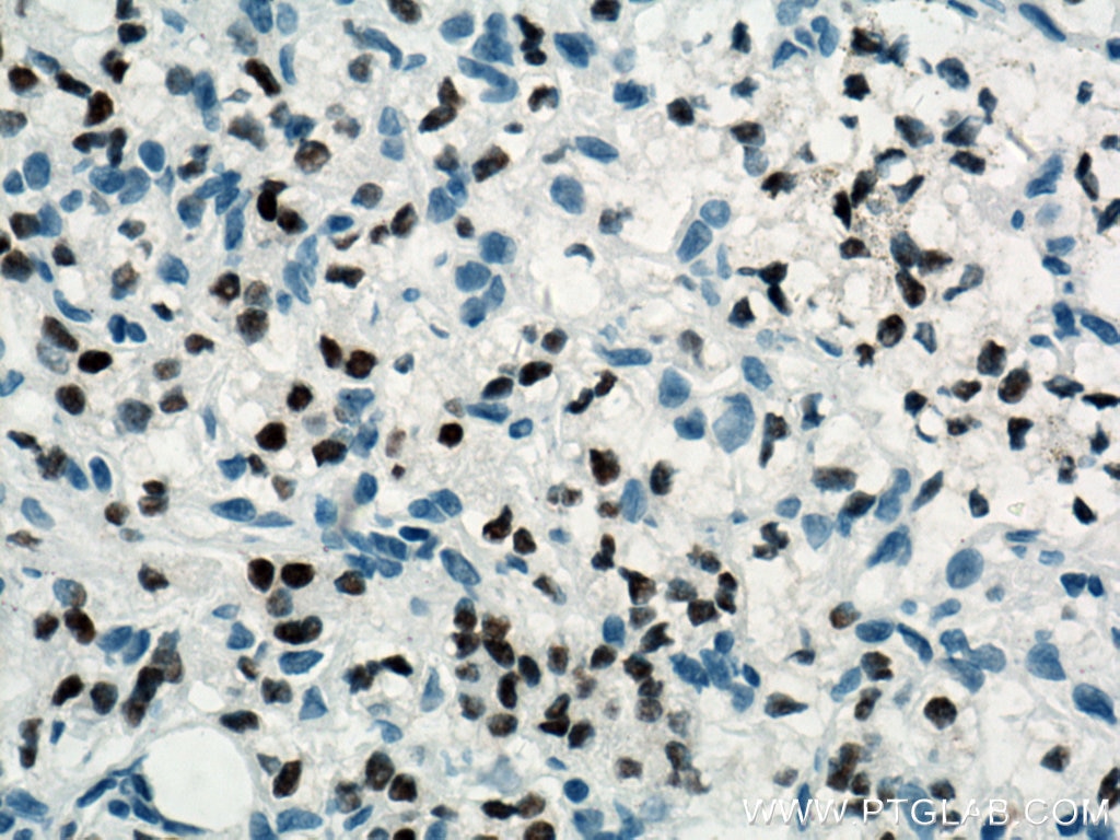 PAX8 Antibody IHC human renal cell carcinoma tissue 60145-4-Ig