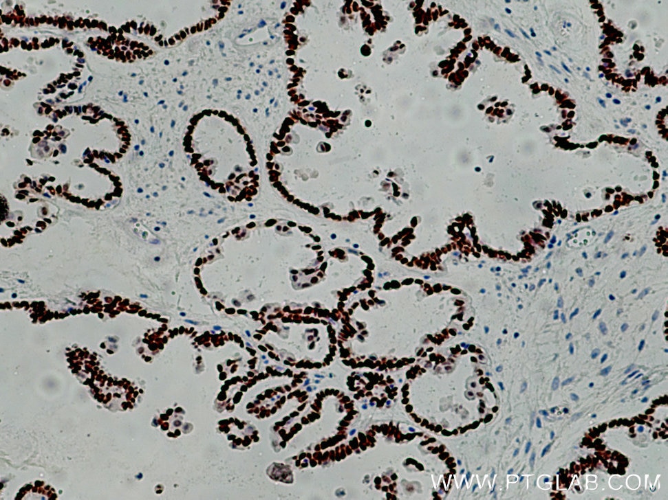 Immunohistochemistry (IHC) staining of human ovary tumor tissue using PAX8 Monoclonal antibody (60145-4-Ig)