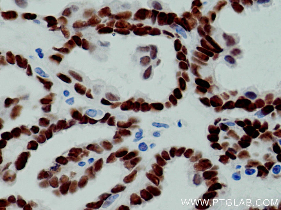 Immunohistochemistry (IHC) staining of human ovary tumor tissue using PAX8 Monoclonal antibody (60145-4-Ig)