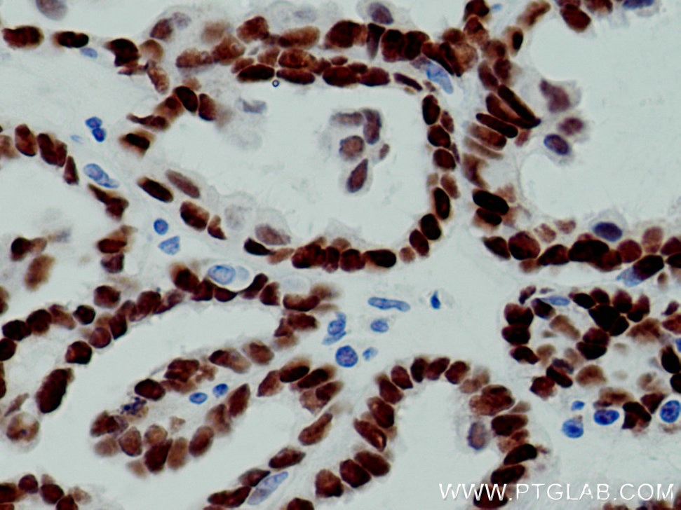 IHC staining of human ovary tumor using 60145-4-Ig