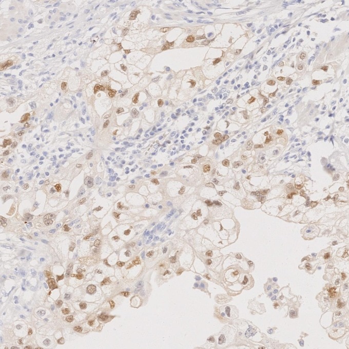 IHC staining of human ovary cancer using 60145-4-Ig Immunohistochemistry (IHC) staining of human ovary cancer tissue using PAX8 Monoclonal antibody (60145-4-Ig)
