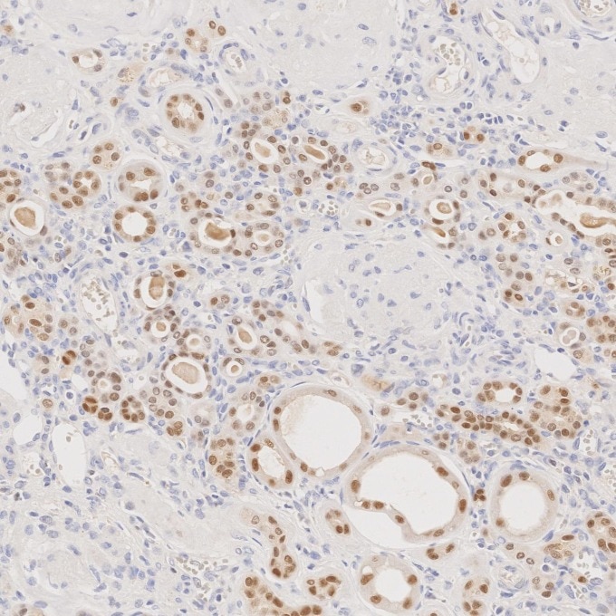 IHC staining of human renal cell carcinoma using 60145-4-Ig Immunohistochemistry (IHC) staining of human renal cell carcinoma tissue using PAX8 Monoclonal antibody (60145-4-Ig)
