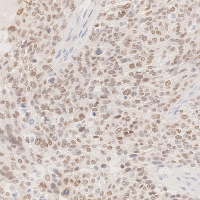 IHC staining of human ovary cancer using 60145-4-Ig Immunohistochemistry (IHC) staining of human ovary cancer tissue using PAX8 Monoclonal antibody (60145-4-Ig)