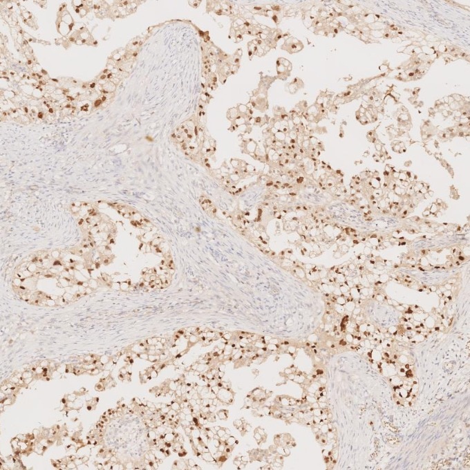 IHC staining of human ovary cancer using 60145-4-Ig Immunohistochemistry (IHC) staining of human ovary cancer tissue using PAX8 Monoclonal antibody (60145-4-Ig)