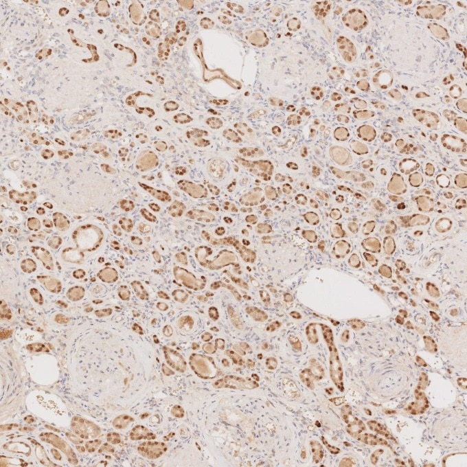 IHC staining of human renal cell carcinoma using 60145-4-Ig Immunohistochemistry (IHC) staining of human renal cell carcinoma tissue using PAX8 Monoclonal antibody (60145-4-Ig)