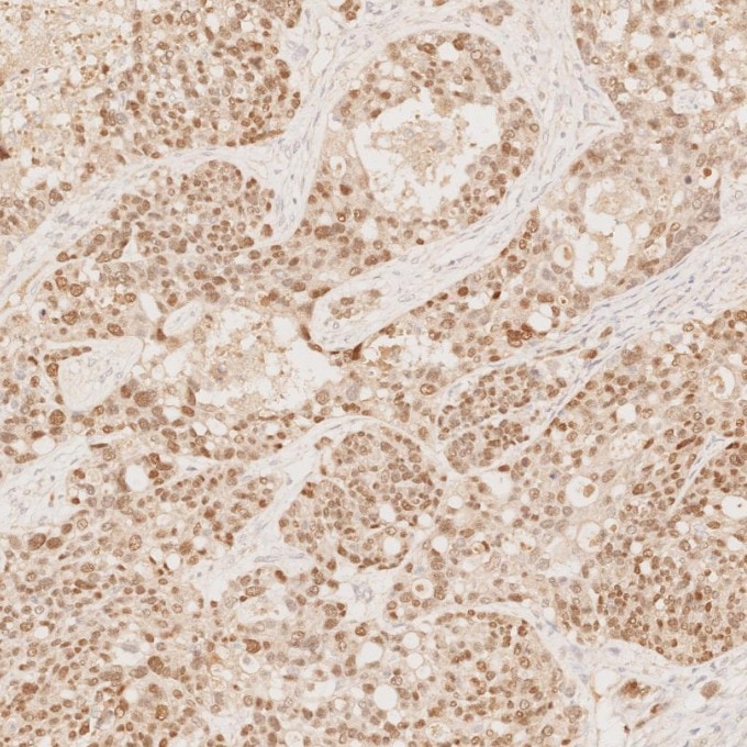 IHC staining of human ovary cancer using 60145-4-Ig Immunohistochemistry (IHC) staining of human ovary cancer tissue using PAX8 Monoclonal antibody (60145-4-Ig)