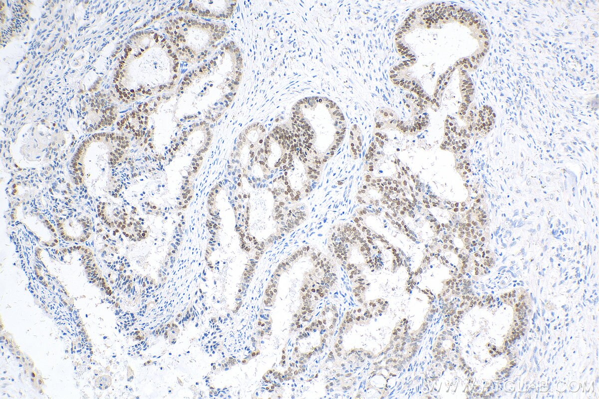 Immunohistochemistry (IHC) staining of human ovary tumor tissue using PAX8 Recombinant antibody (80756-1-RR)