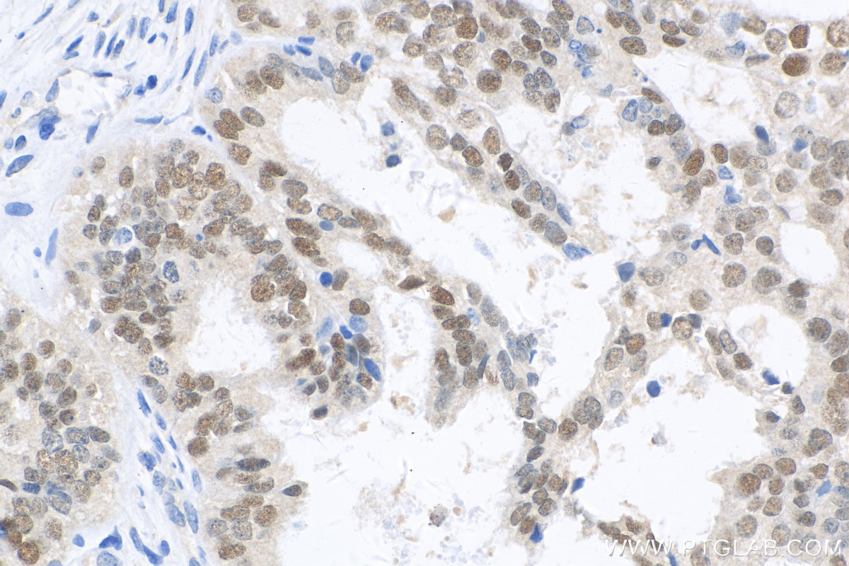 Immunohistochemistry (IHC) staining of human ovary tumor tissue using PAX8 Recombinant antibody (80756-1-RR)