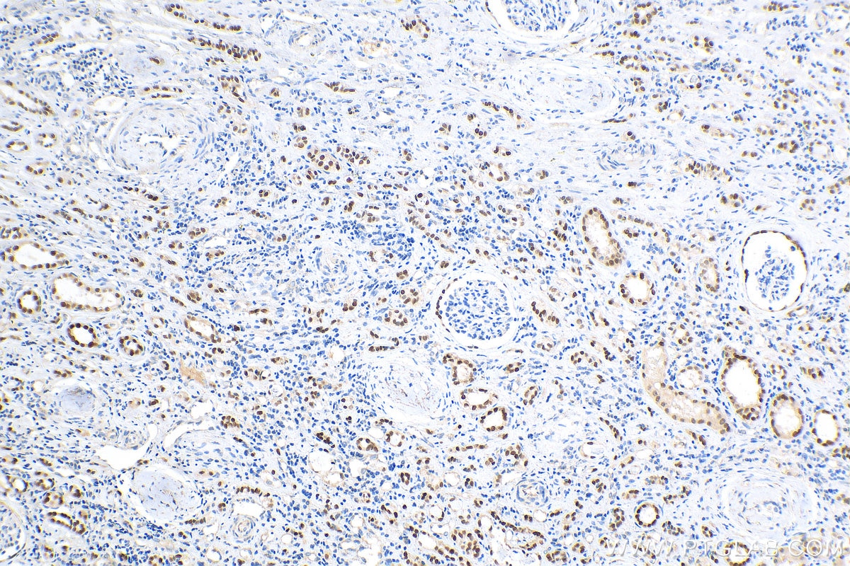 Immunohistochemistry (IHC) staining of human renal cell carcinoma tissue using PAX8 Recombinant antibody (80756-1-RR)