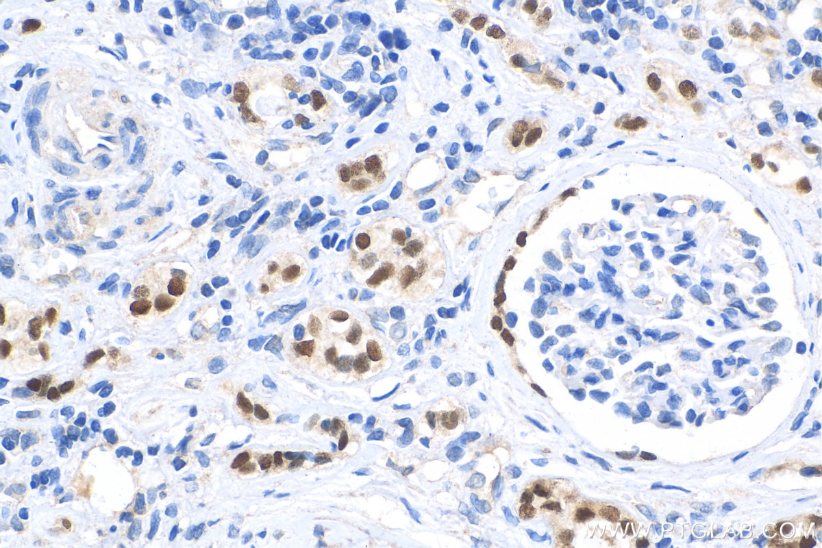 Immunohistochemistry (IHC) staining of human renal cell carcinoma tissue using PAX8 Recombinant antibody (80756-1-RR)