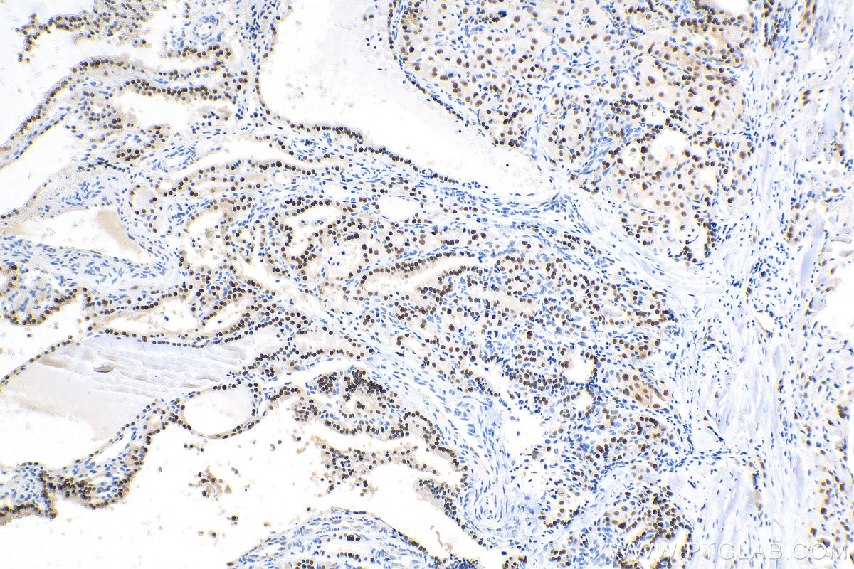 Immunohistochemistry (IHC) staining of human thyroid cancer tissue using PAX8 Recombinant antibody (80756-1-RR)