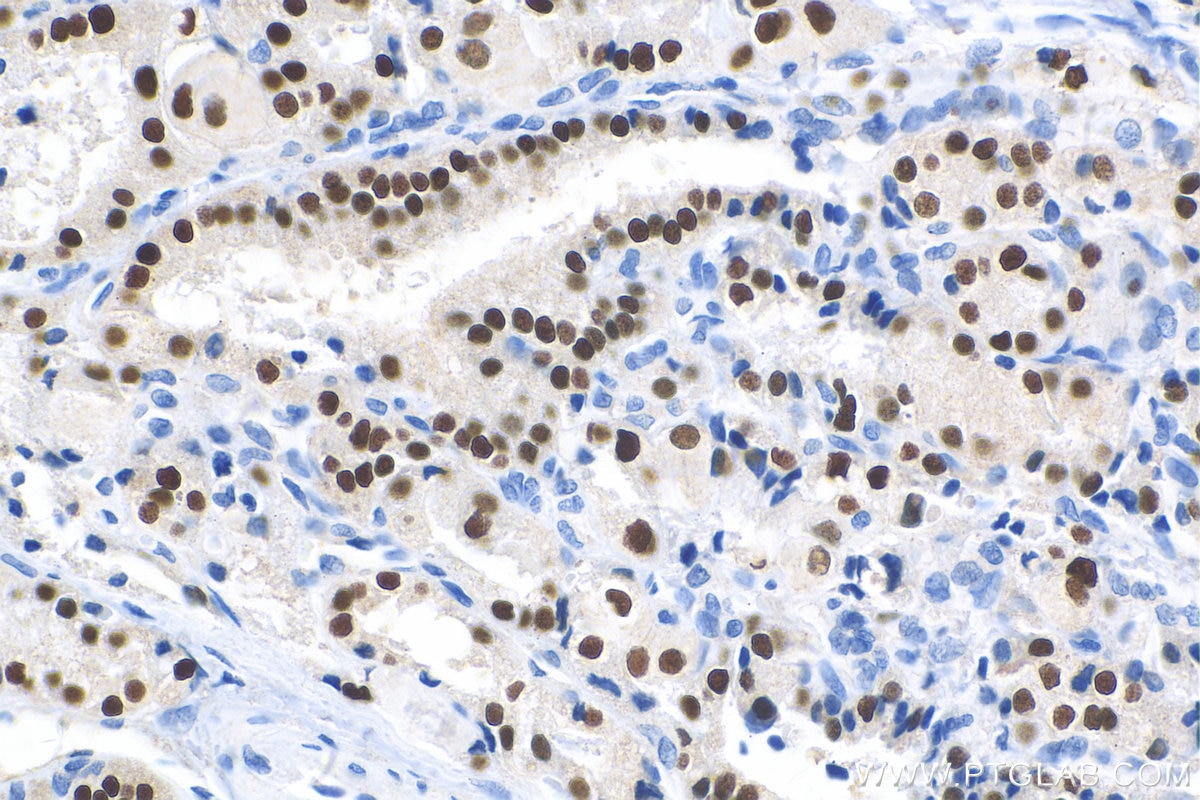 Immunohistochemistry (IHC) staining of human thyroid cancer tissue using PAX8 Recombinant antibody (80756-1-RR)