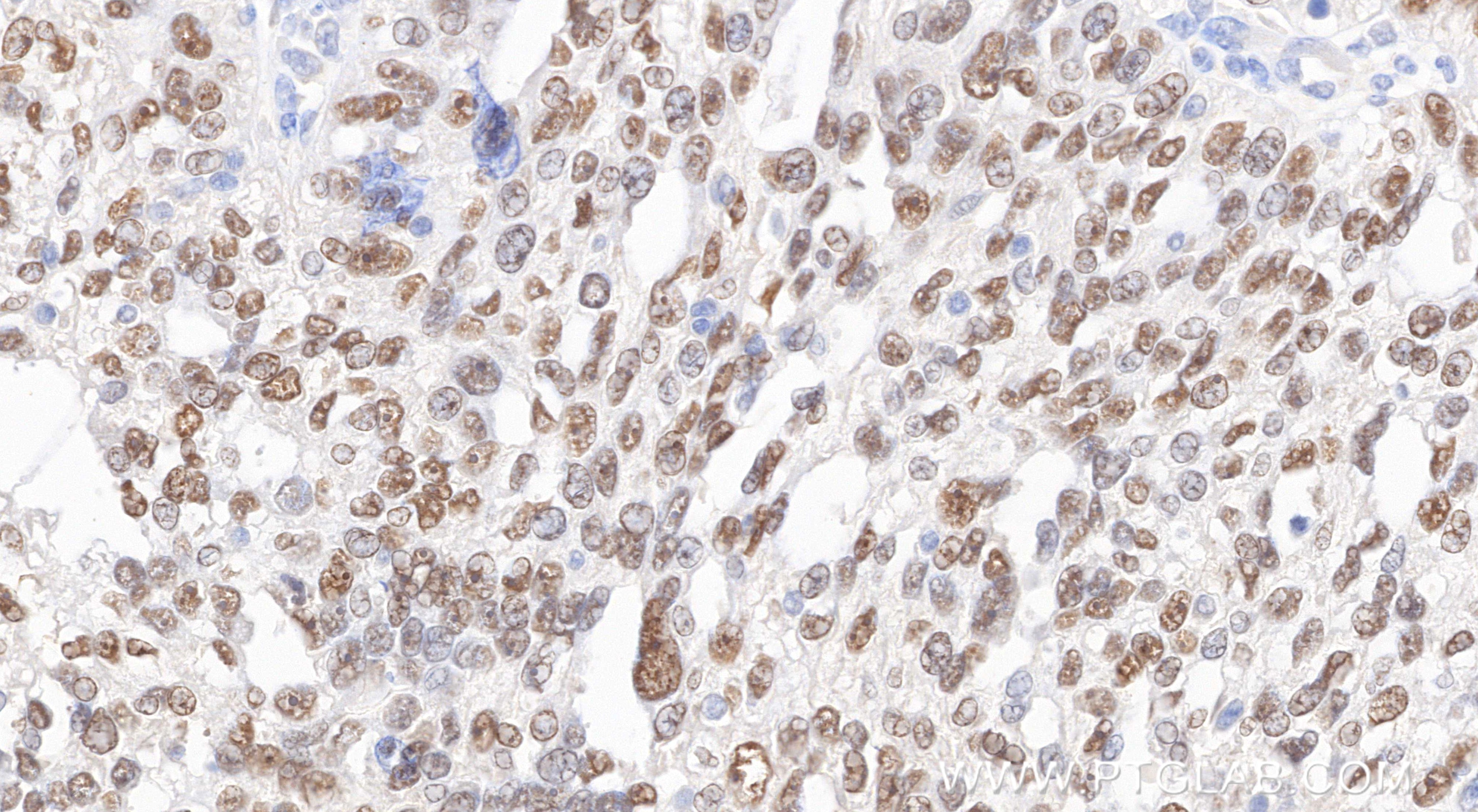 Immunohistochemical analysis of paraffin-embedded human ovary cancer tissue slide using 80756-1-RR (PAX8 antibody) at dilution of 1:5000 (under 40x lens). Heat mediated antigen retrieval with Tris-EDTA buffer (pH 9.0). Immunohistochemistry (IHC) staining of human ovary cancer tissue using PAX8 Recombinant monoclonal antibody (80756-1-RR)