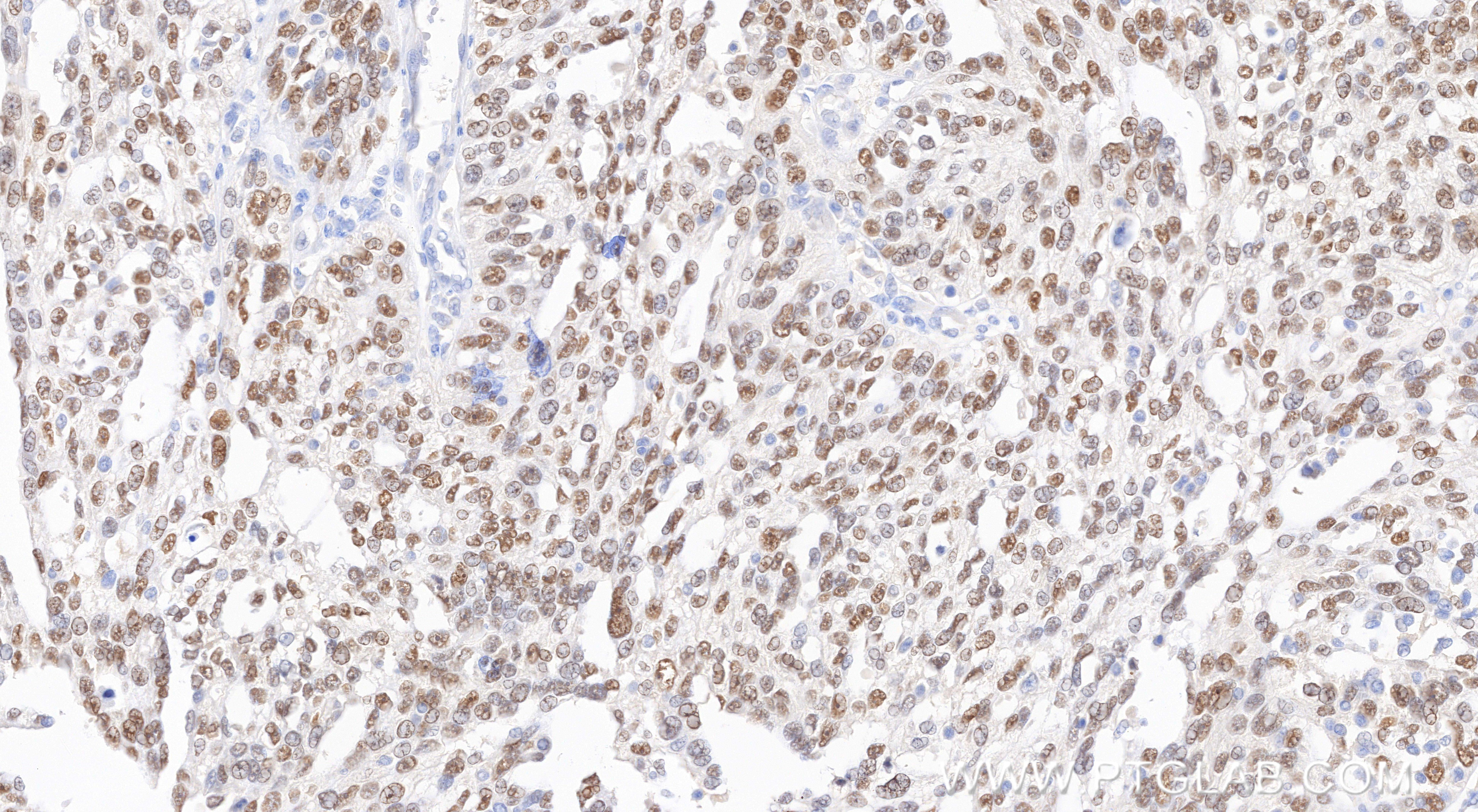 Immunohistochemical analysis of paraffin-embedded human ovary cancer tissue slide using 80756-1-RR (PAX8 antibody) at dilution of 1:5000 (under 20x lens). Heat mediated antigen retrieval with Tris-EDTA buffer (pH 9.0). Immunohistochemistry (IHC) staining of human ovary cancer tissue using PAX8 Recombinant monoclonal antibody (80756-1-RR)